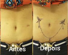  Cobertura de cicatriz na barriga