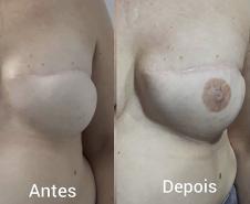Reconstrução da auréola mamária após cirurgia de remoção de mama 