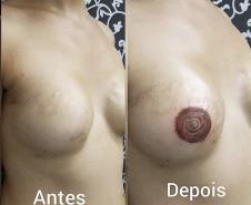 Reconstrução da auréola mamária após cirurgia de remoção da mama