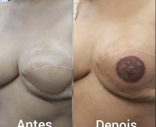 Reconstrução da auréola mamária após cirurgia de remoção das mamas